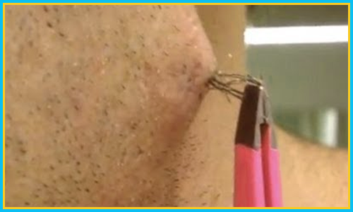 Removes Ingrown Hair with Laser Hair removal Treatment in Hyderabad